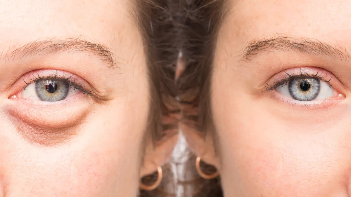 under-eye bags before and after