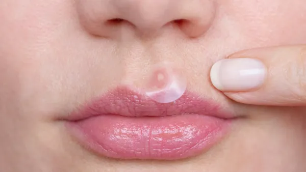 Pimple-Patch-Stock-Photo