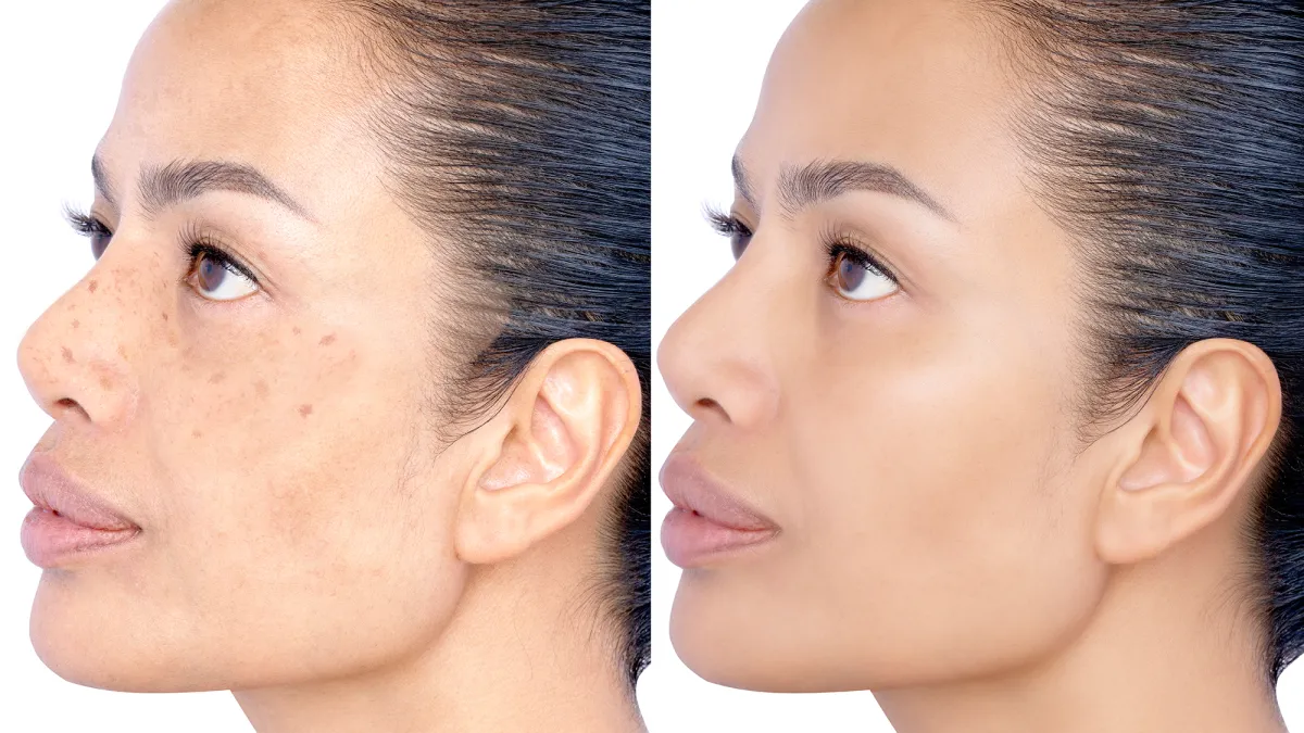 amazon-dark-spot-cream