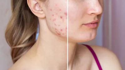 before-after-adult-acne