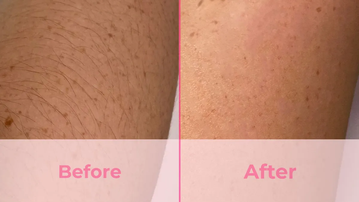 hair removal devices