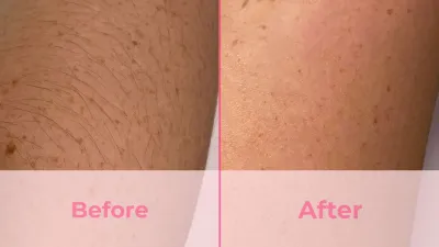 hair removal devices