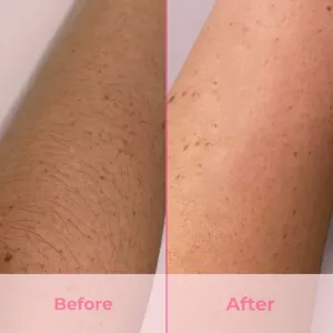 hair removal devices