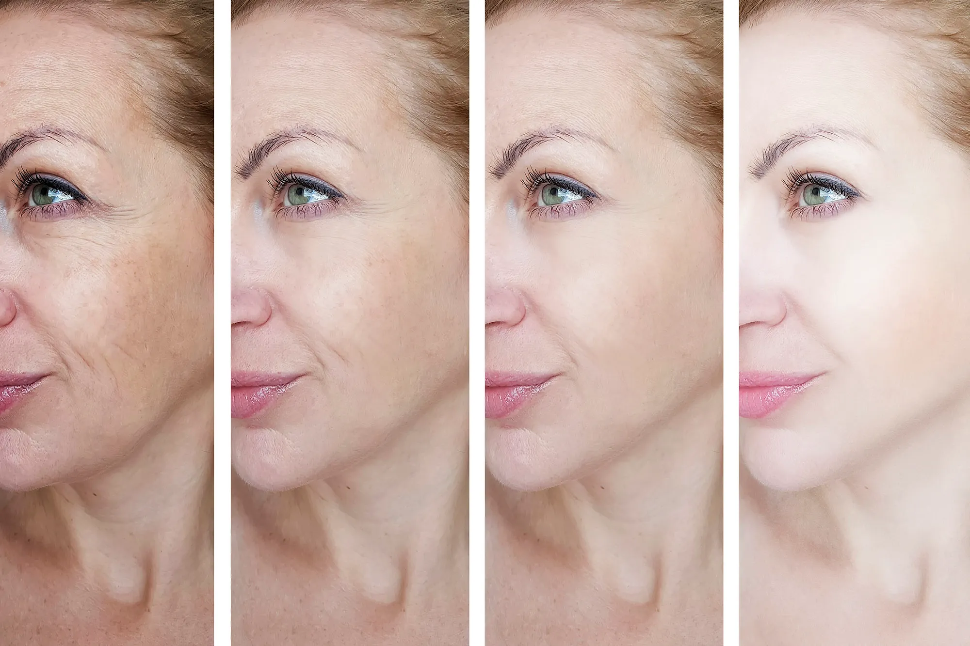 female eye wrinkles before and after treatments