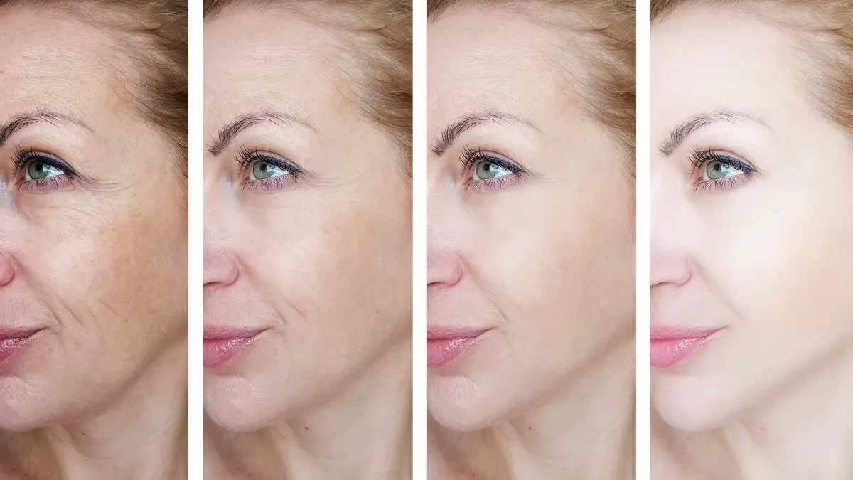 female eye wrinkles before and after treatments