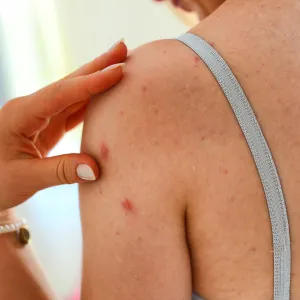 Body-Acne
