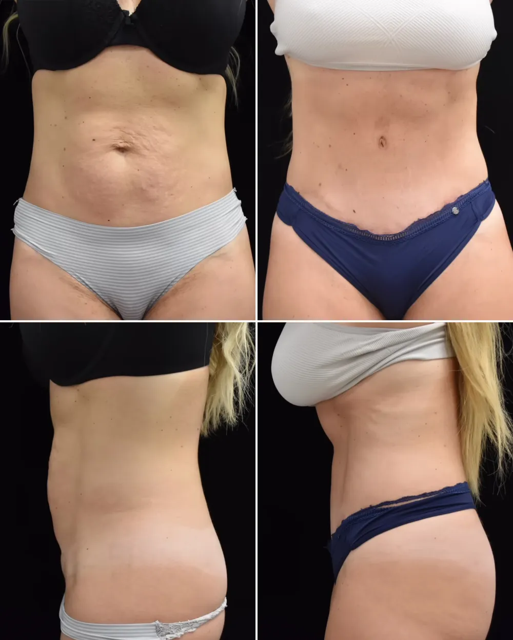 &lsquo;RHONJ&rsquo; Star Danielle Cabral Reveals Tummy Tuck Results After Commenting on People&rsquo;s Ozempic Use