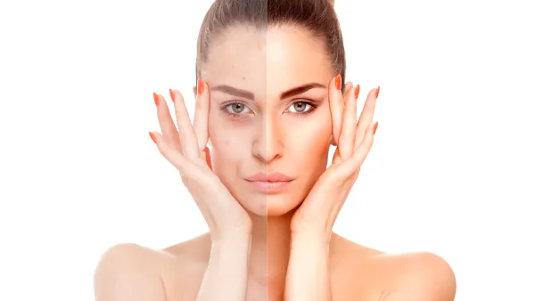 Close-up of a woman face divided in two parts - no retouch with red skin and acne and good beauty retouch.