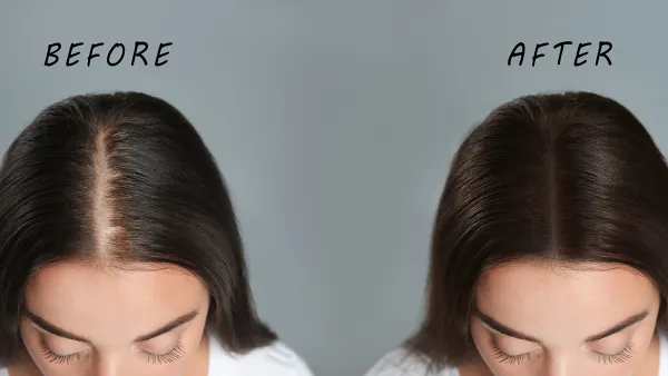 Woman with hair loss problem before and after treatment on grey background, collage. Visiting trichologist