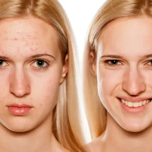 hormonal acne before and after