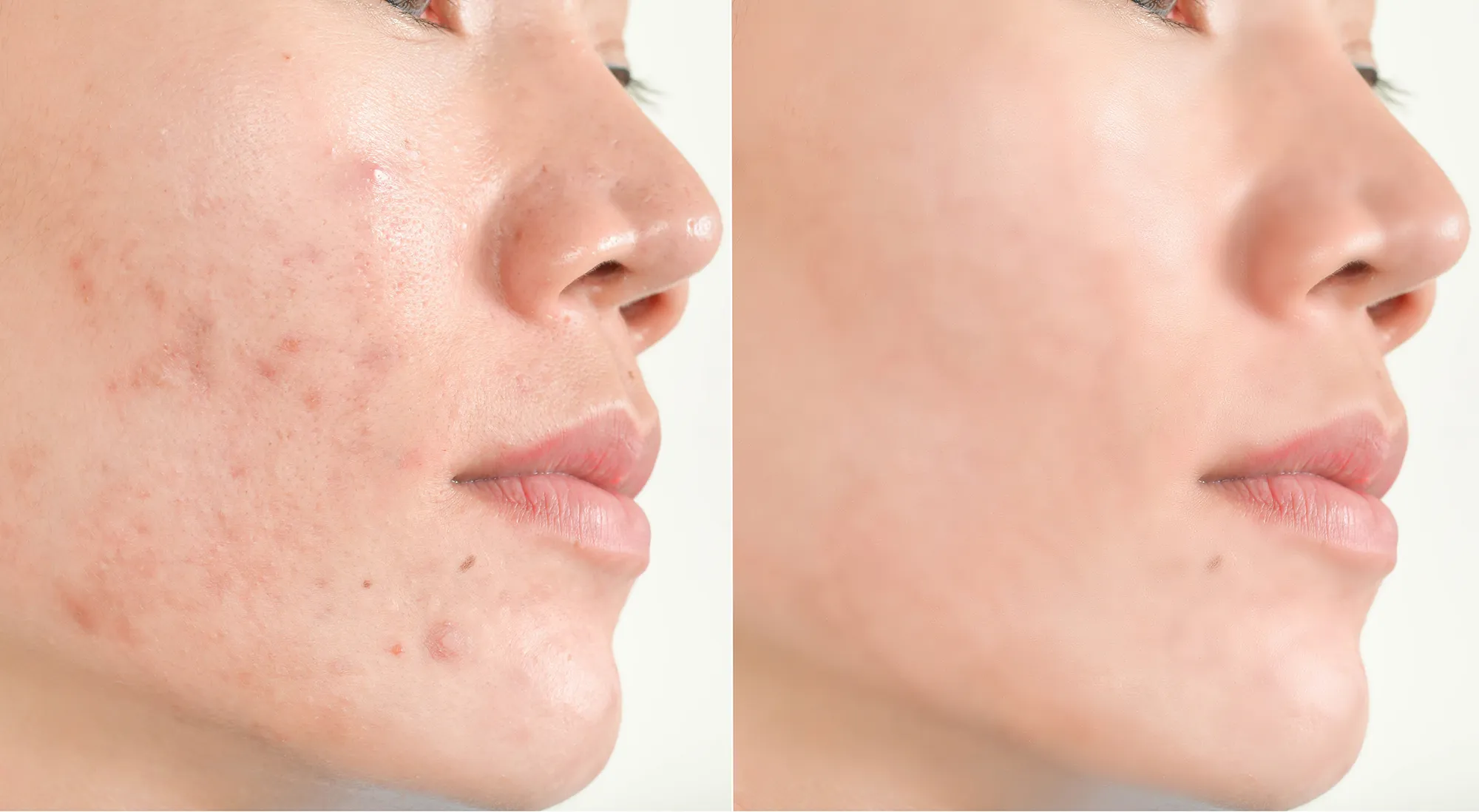 Acne scars and pores. Black spots, wrinkles and skin problems Facial Treatment Step