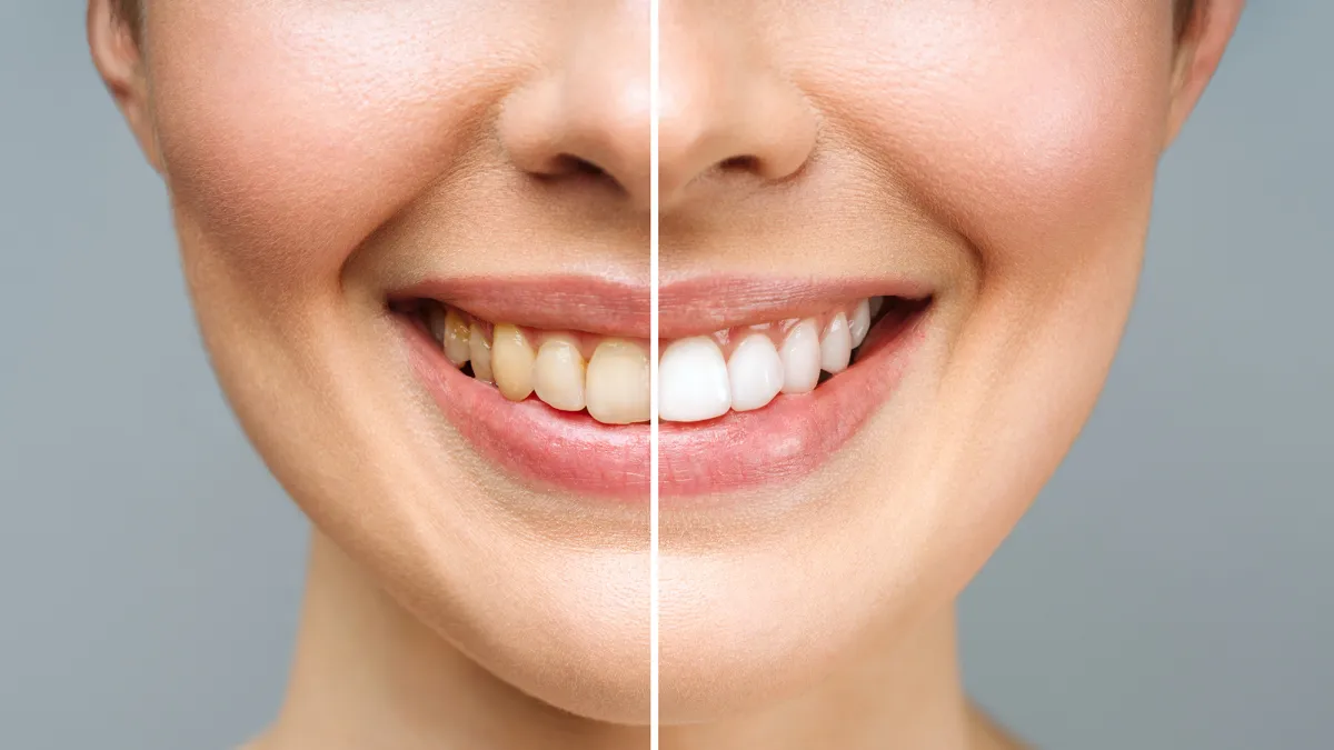woman teeth before and after whitening. Over white background. Dental clinic patient. Image symbolizes oral care dentistry, stomatology