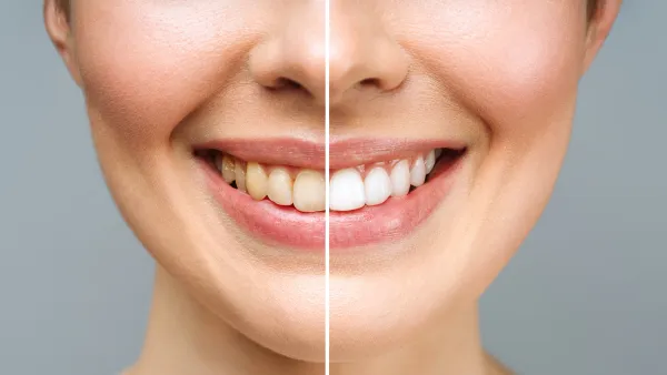woman teeth before and after whitening. Over white background. Dental clinic patient. Image symbolizes oral care dentistry, stomatology