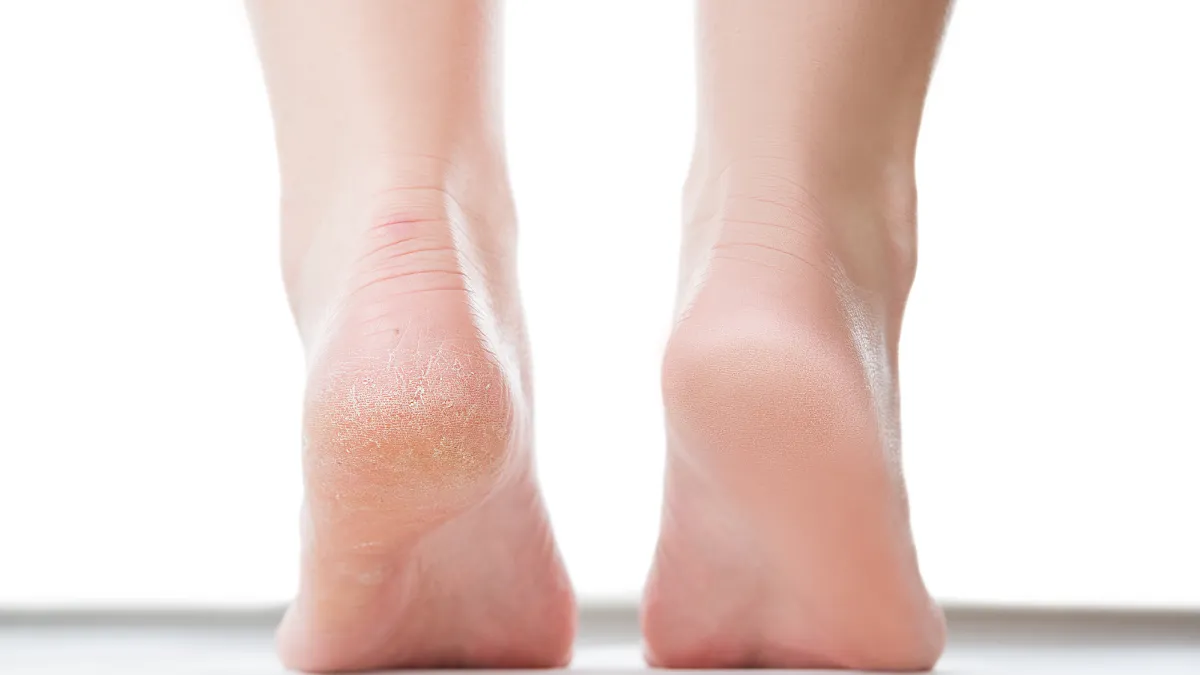 Before after feet care concept, female foot, chiropody isolated on white background, studio shot