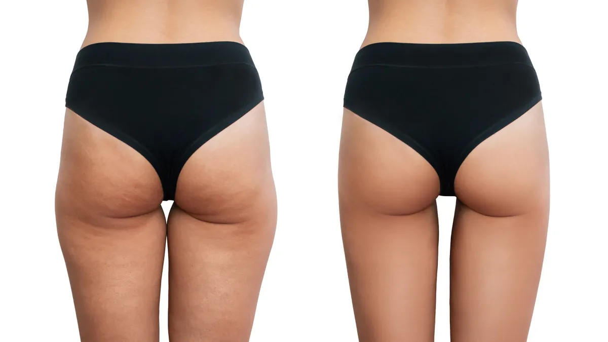 Young woman's thighs with cellulite before and after treatment isolated on white background.