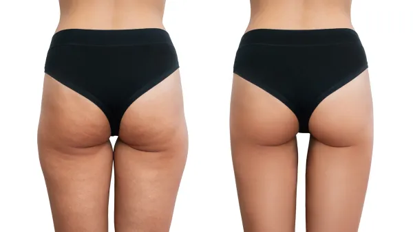 Young woman's thighs with cellulite before and after treatment isolated on white background.