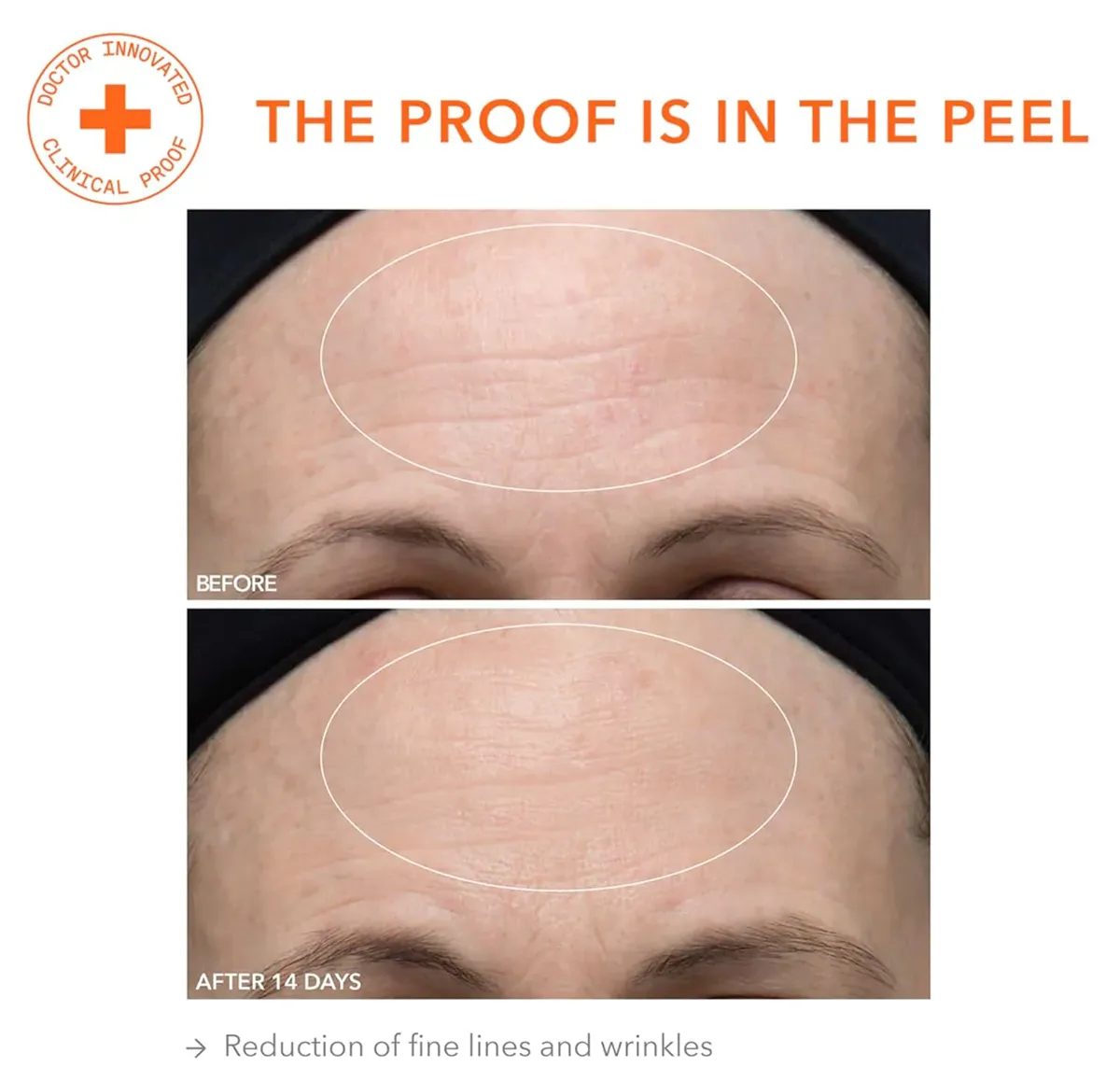 dr-dennis-gross-peel-before-after