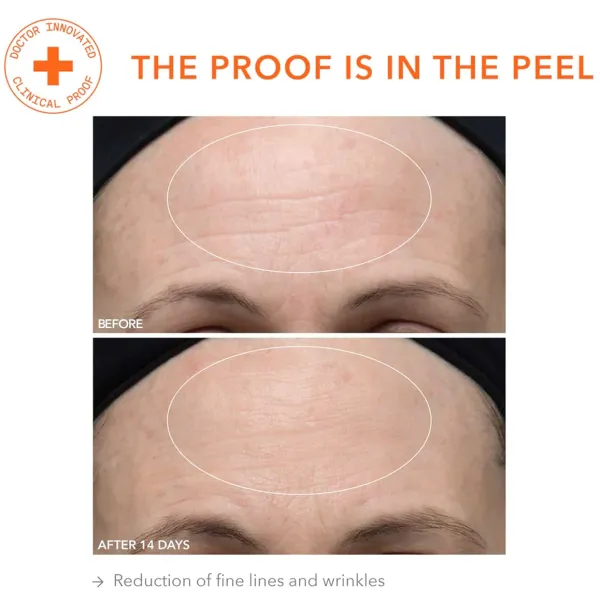 dr-dennis-gross-peel-before-after