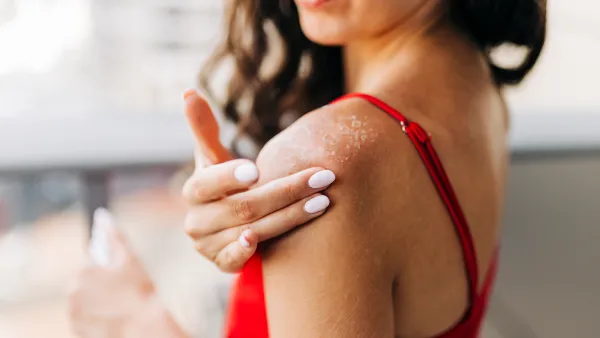 Close up of woman applying moisturizer on sunburned skin