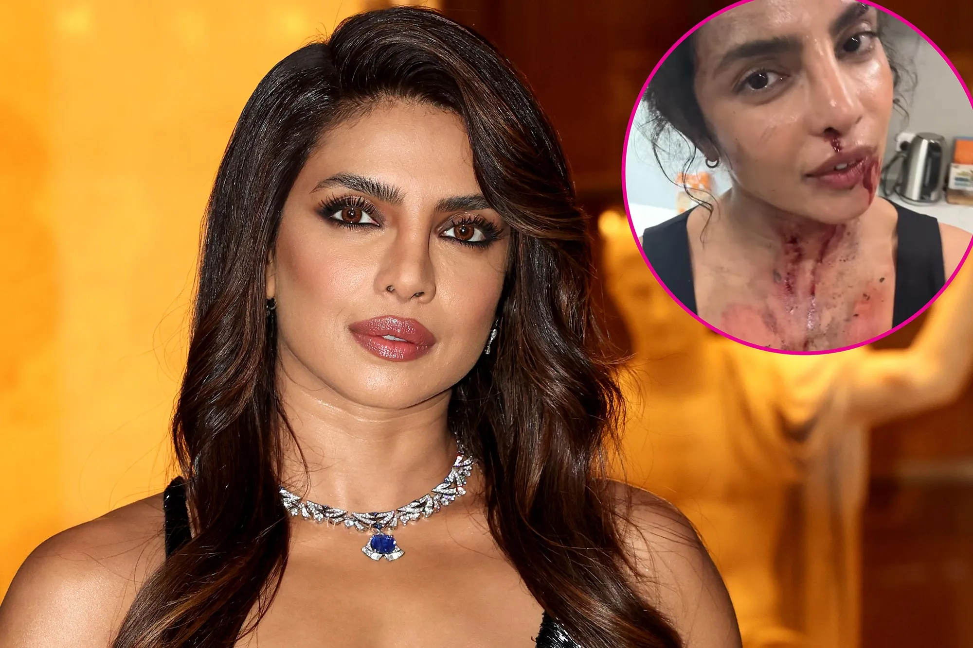 Priyanka Chopra Is Bruised and Bloody on Set of New Movie