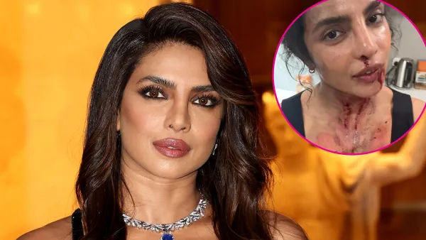 Priyanka Chopra Is Bruised and Bloody on Set of New Movie