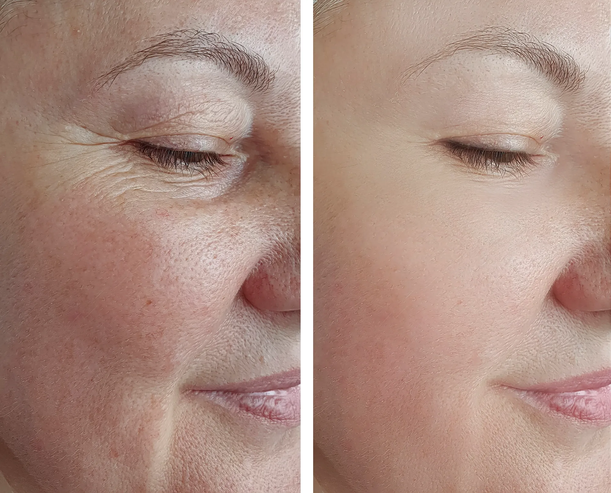 woman face wrinkles before and after treatment arrow