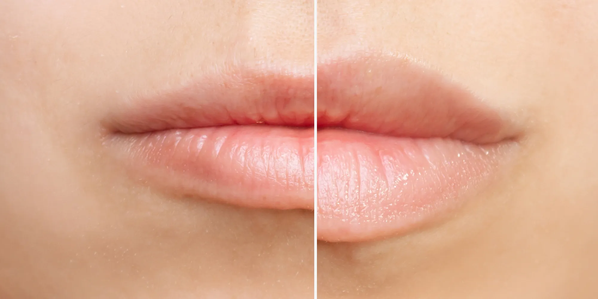 Result of lip augmentation. Cropped shot of young woman's lower part of face with lips before and after lip enhancement. Injection of filler in lips