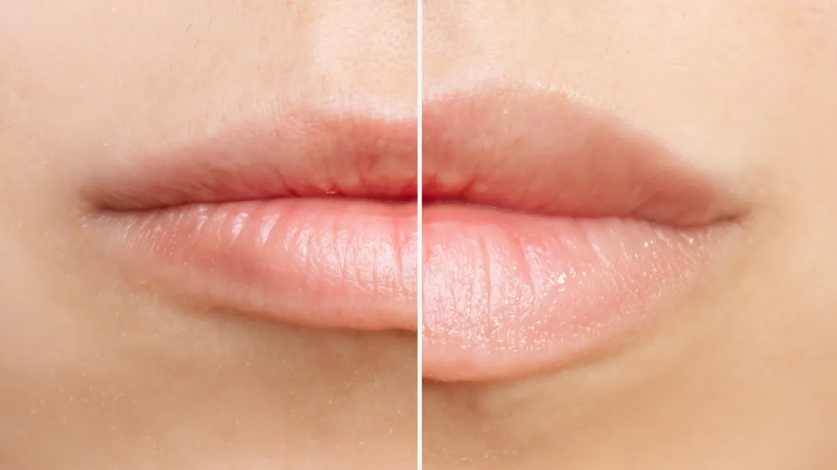Result of lip augmentation. Cropped shot of young woman's lower part of face with lips before and after lip enhancement. Injection of filler in lips