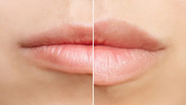 Result of lip augmentation. Cropped shot of young woman's lower part of face with lips before and after lip enhancement. Injection of filler in lips