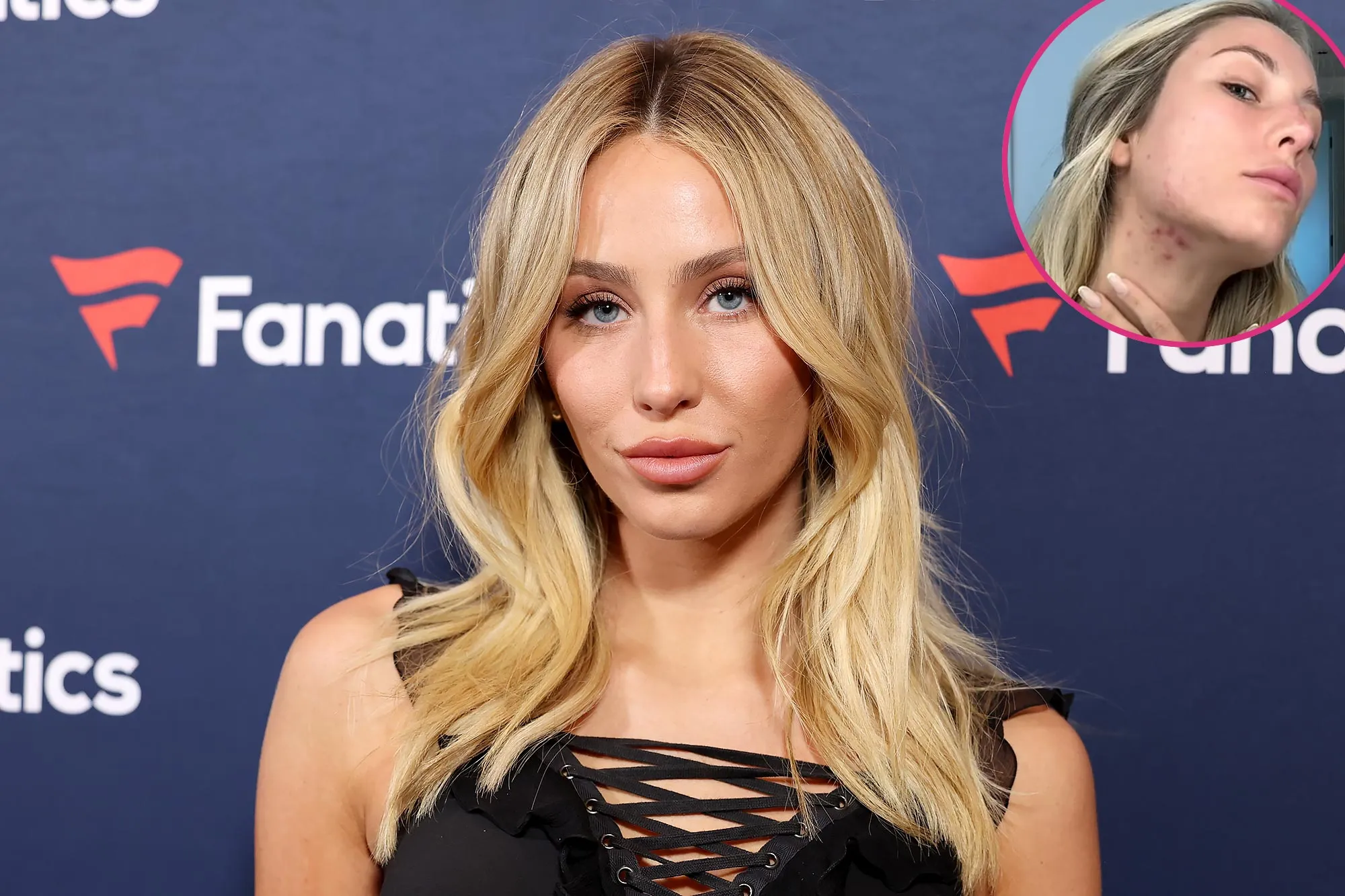 Alix Earle Shares Her Go to Method of Concealing Acne