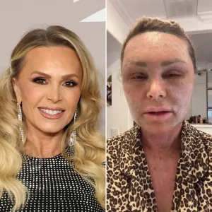 Promo Tamra Judge Shows Intense Facial Swelling After Plastic Surgery