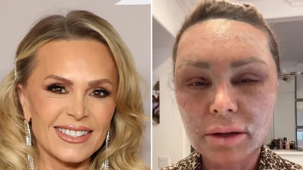 Promo Tamra Judge Shows Intense Facial Swelling After Plastic Surgery