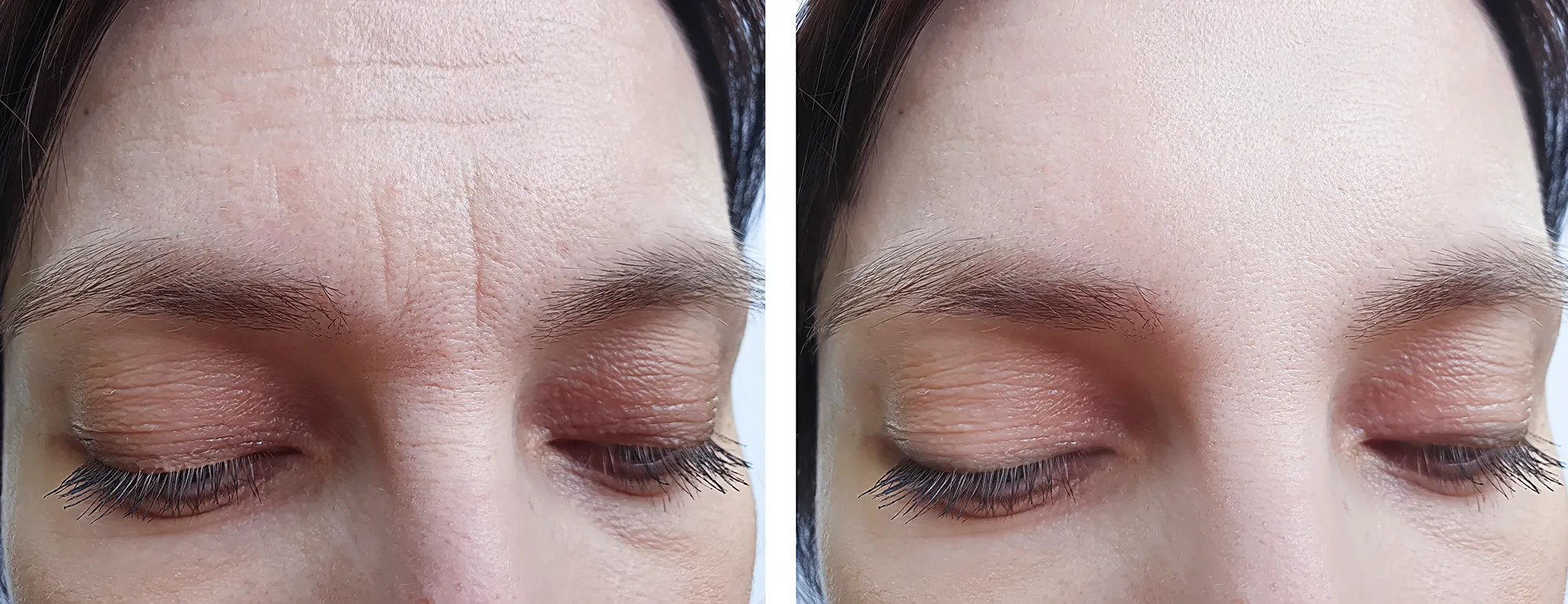 female forehead wrinkles before treatment
