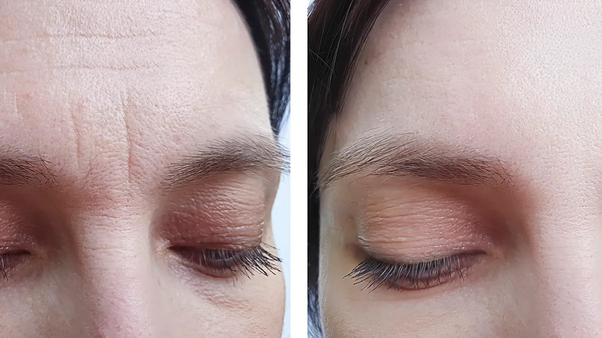 female forehead wrinkles before treatment