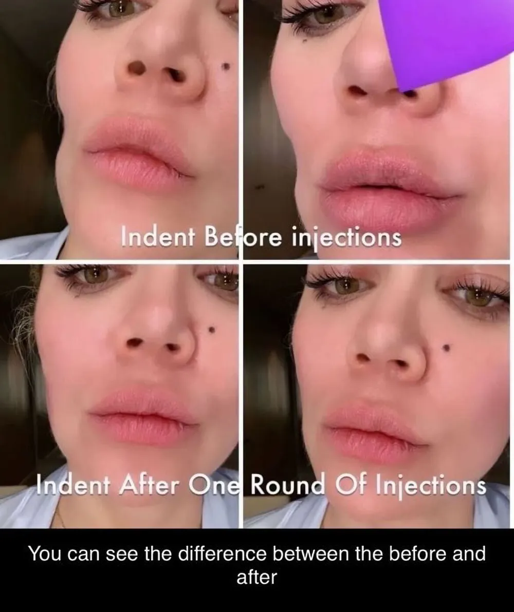 Khloe Kardashian Before andv After Facial Injections