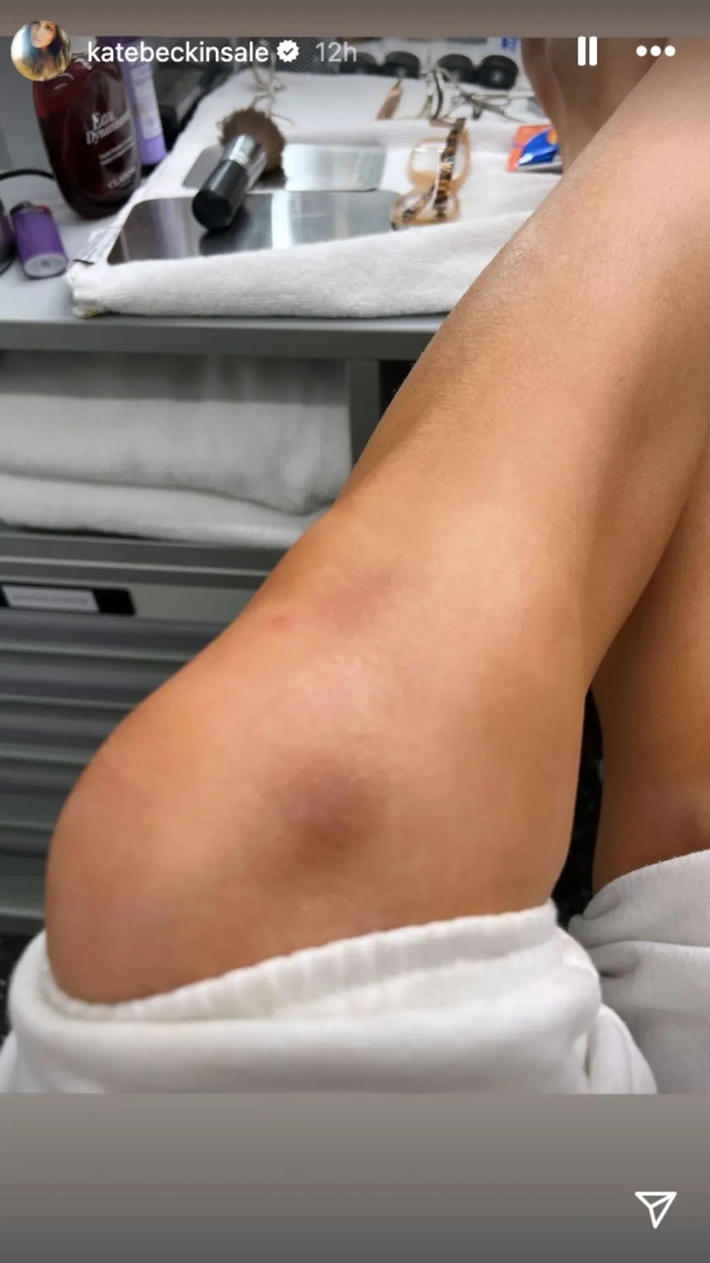 Kate Beckinsale injuries