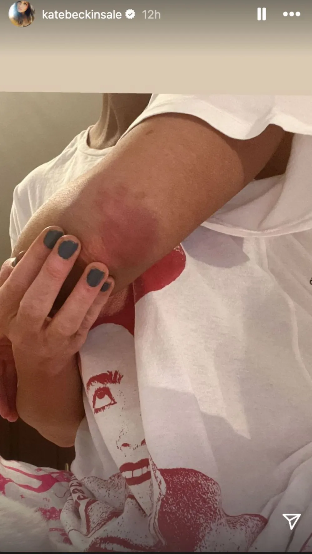 Kate Beckinsale injures