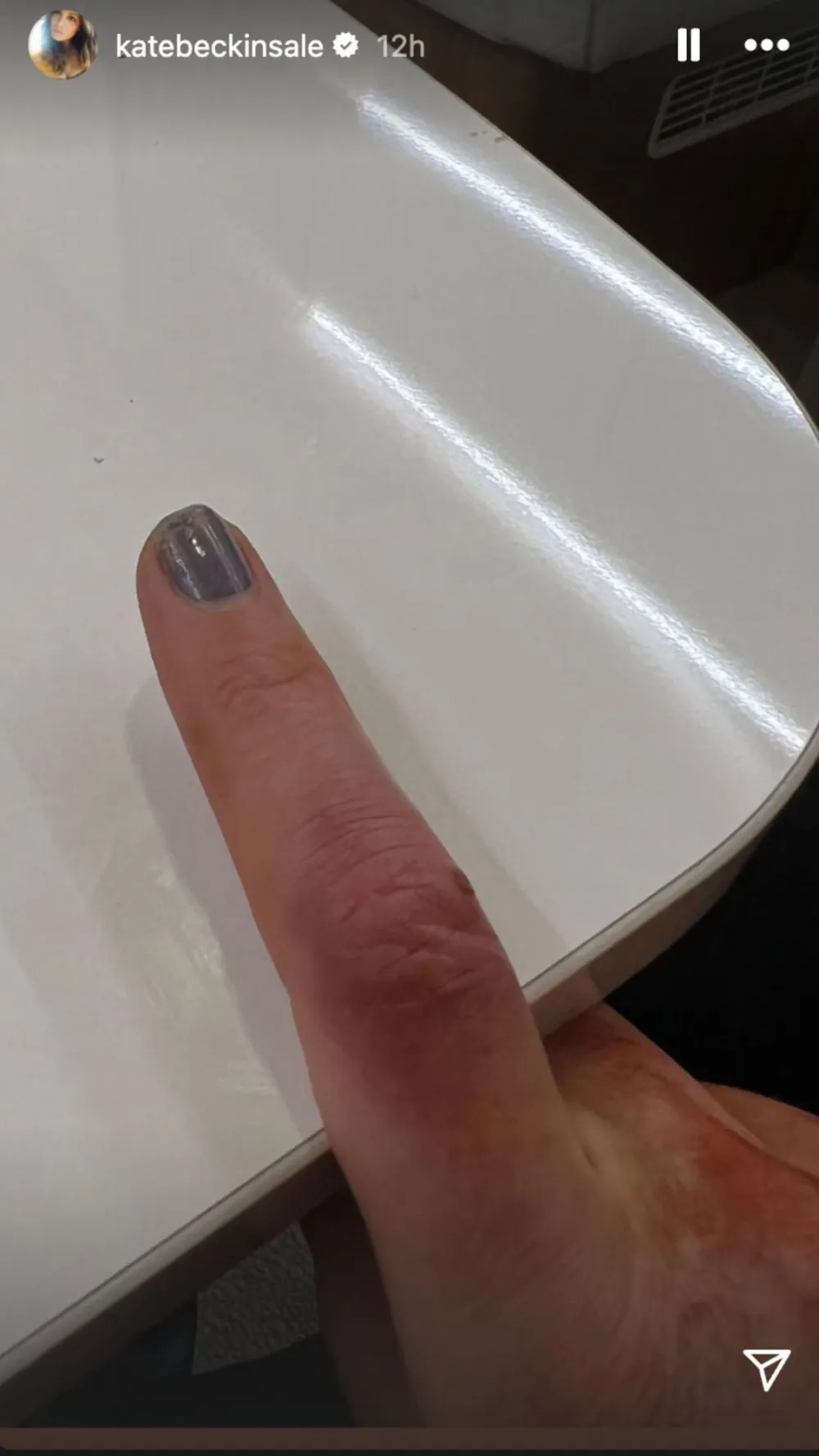 Kate Beckinsale injuries