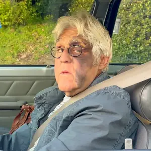 Jay Leno Spotted With Giant Bruise