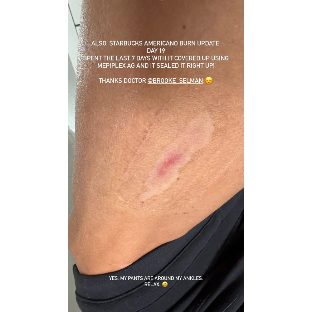 Danica Patrick Offers an Update on Her Nasty Starbucks Burn After Almost 3 Weeks