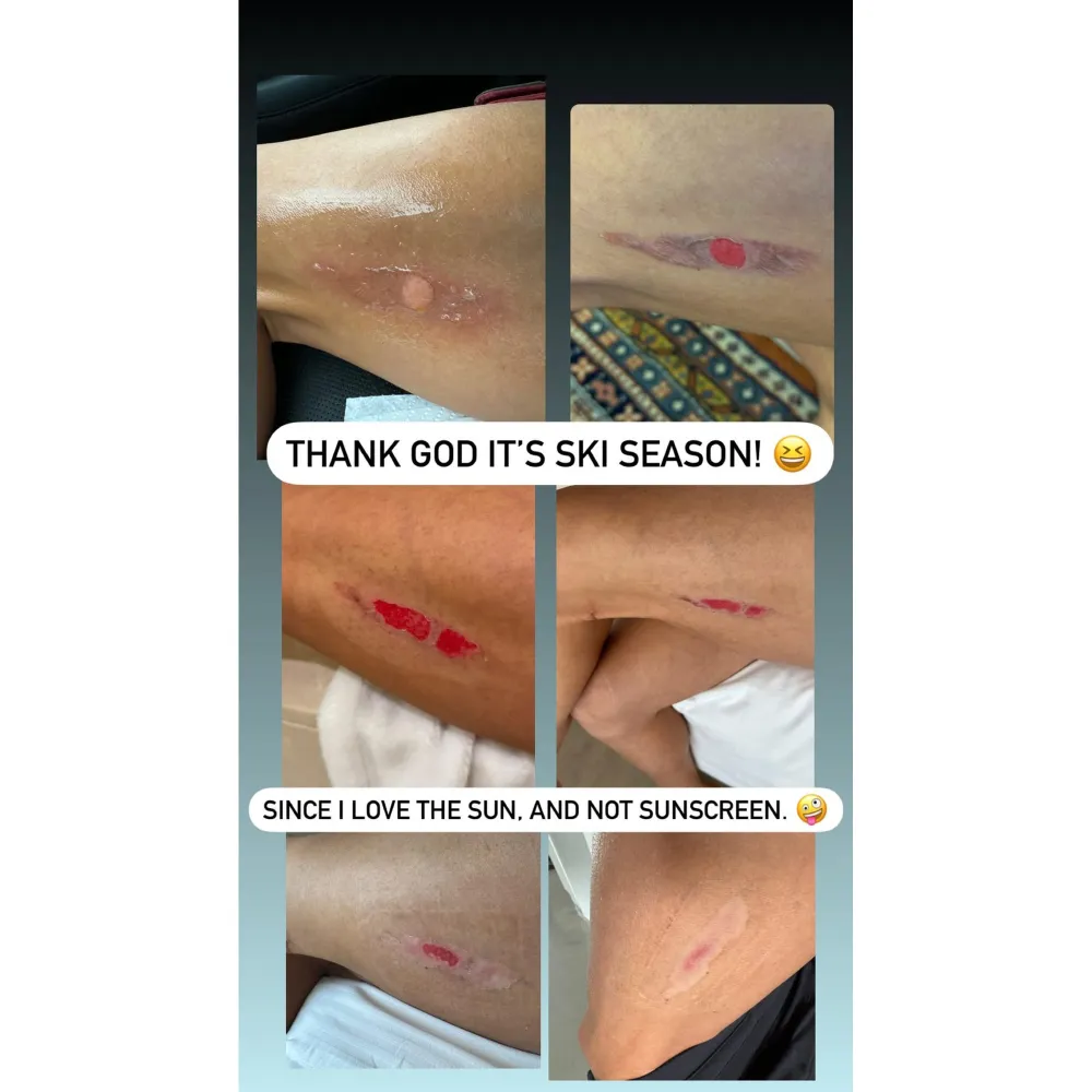 Danica Patrick Offers an Update on Her Nasty Starbucks Burn After Almost 3 Weeks