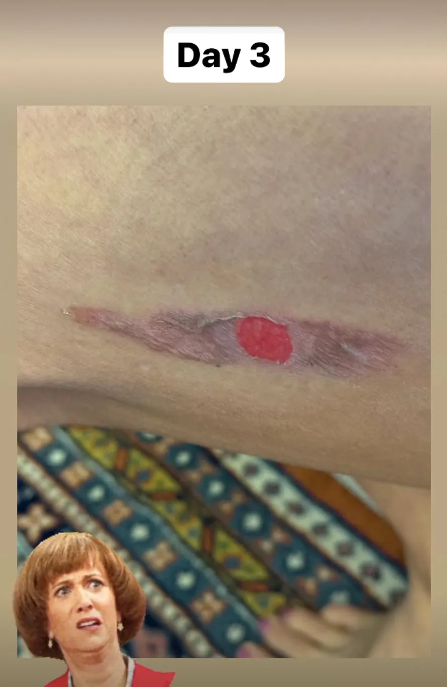 Danica Patrick Shares Gnarly Photos After Getting Burned by Starbucks Hot Water