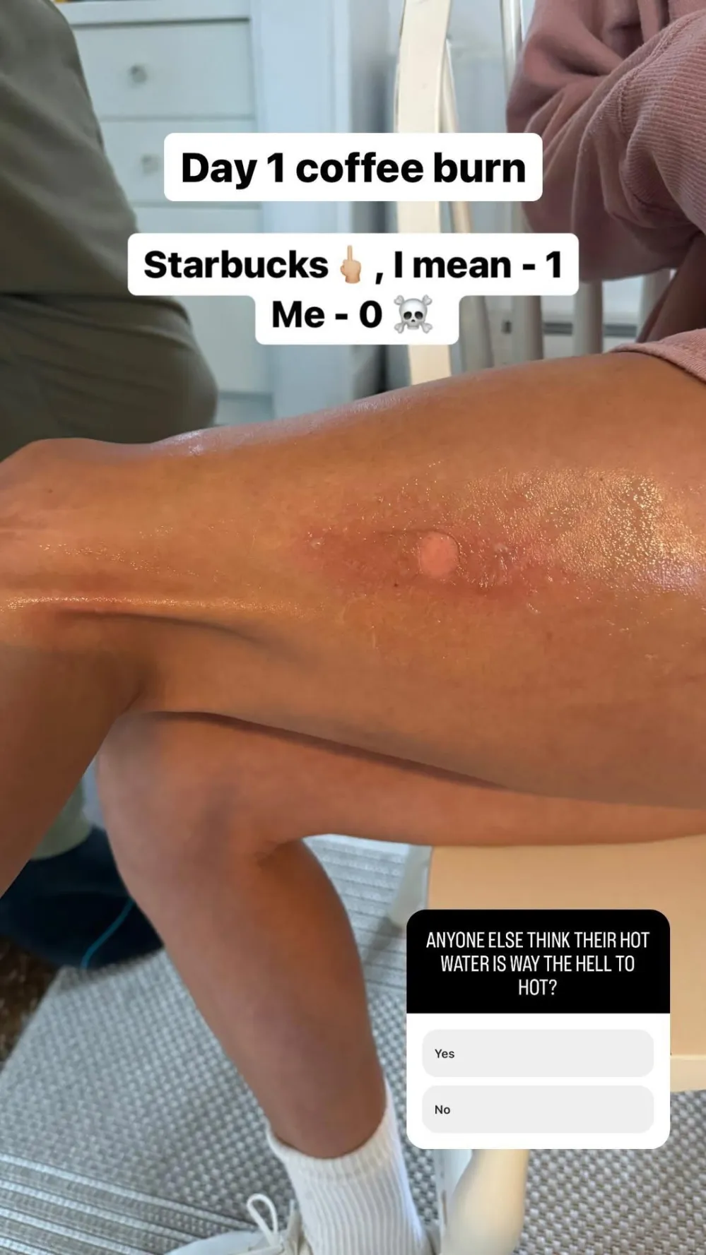 Danica Patrick Shares Gnarly Photos After Getting Burned by Starbucks Hot Water