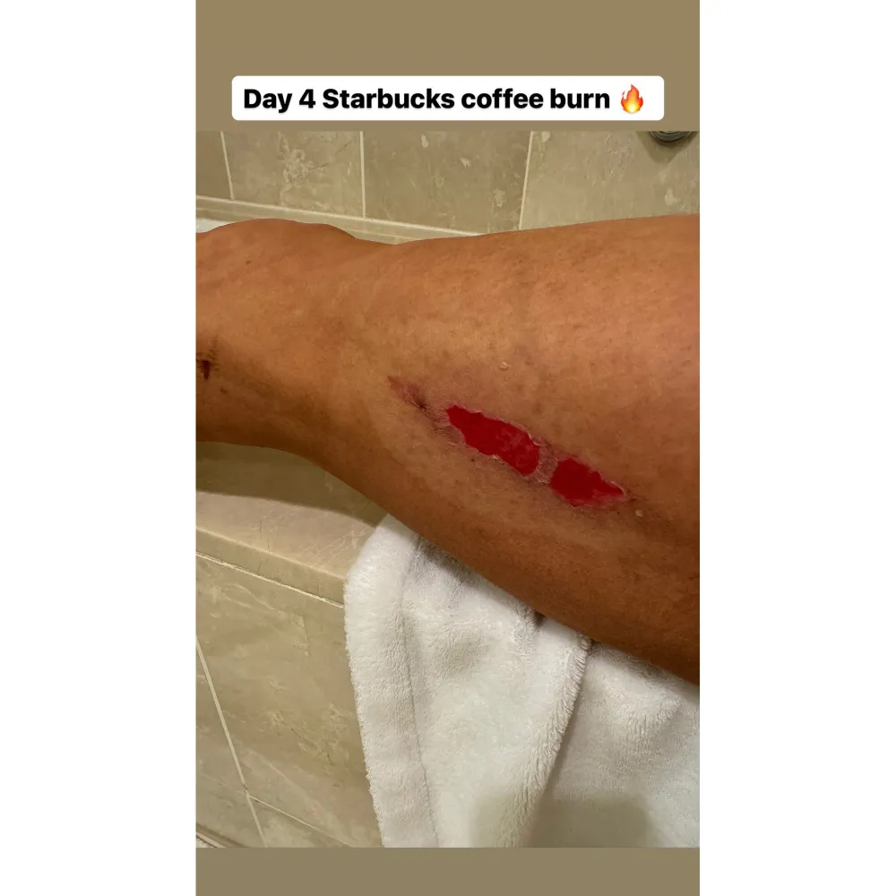 Danica Patrick Shares Grotesque Update About Her Starbucks Water Burn