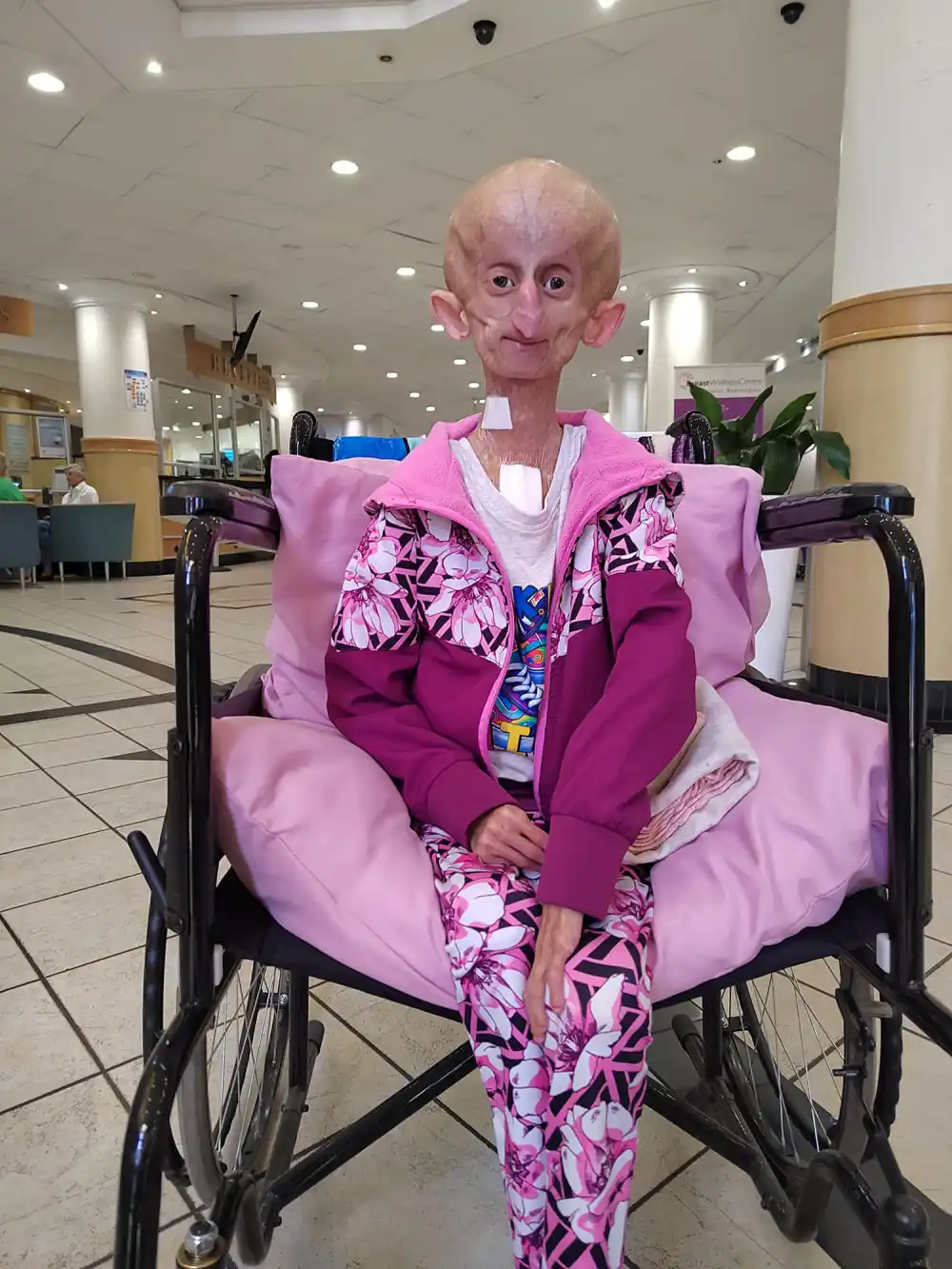 TikTok Star Beandri Booysen Dies at 19 From Rare Aging Disease