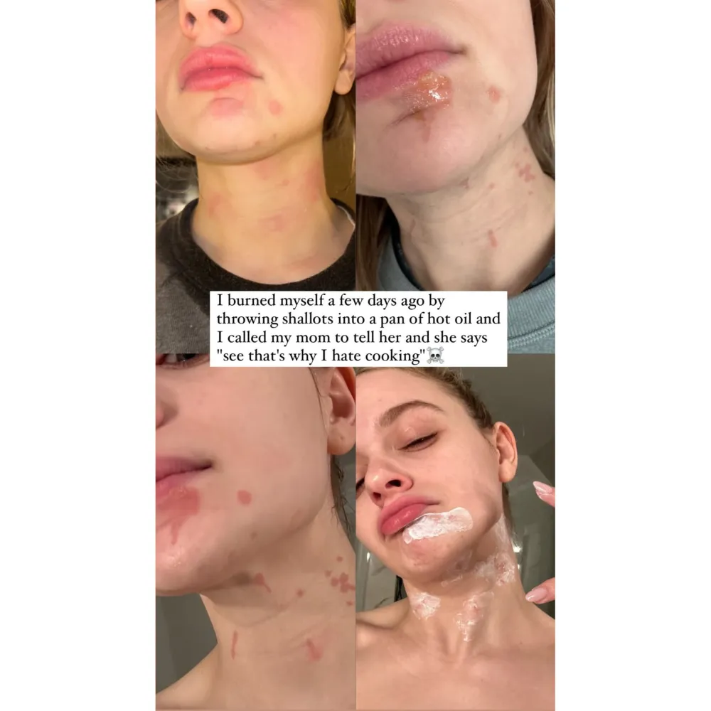 Joey King reveals burns she sustained to her face