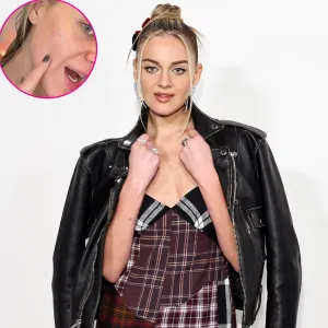 PROMO Kelsea Ballerini Gets a Stress Breakout Before Hitting Stage on Tour