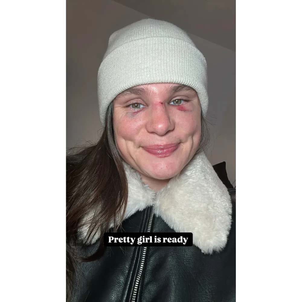 Olympian Ilona Maher Is Not OK After Breaking Her Nose in Rugby Match