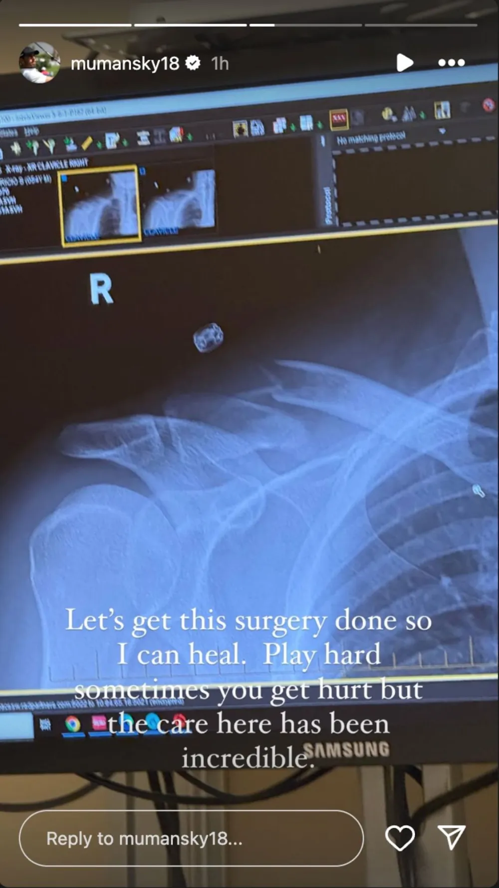 Mauricio Umansky Has a Broken Clavicle