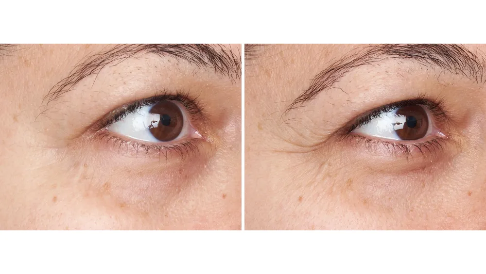 before and after perricone MD